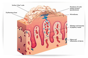 terapie_integrate_psoriasi